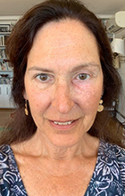 patient Alexandra Shapiro underwent tear-duct surgery