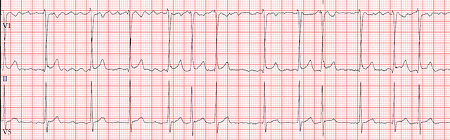 electrocardiogram strip