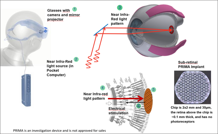 illustrations showing how implanted chip functions for patients with geographic atrophy