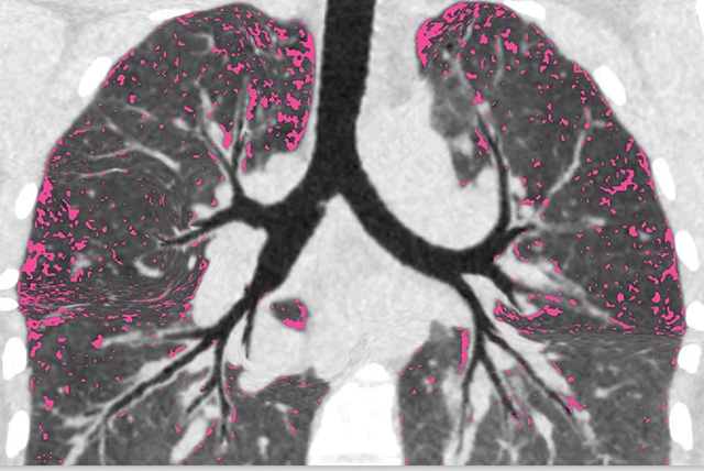 Lungs of a cystic fibrosis patient after modular treatment show less air trapping