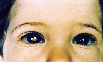 picture of child with retinoblastoma in one eye