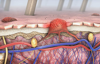 illustration of melanoma