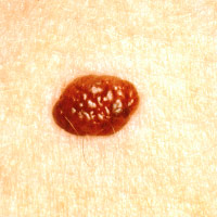 normal mole with border