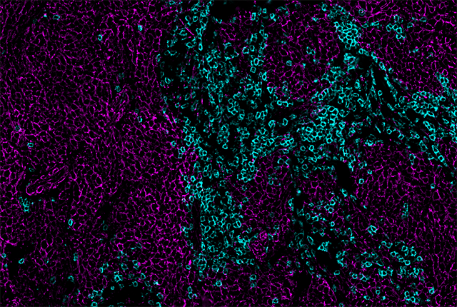 microscopic image of Merkel cell cancer tumor and T cells