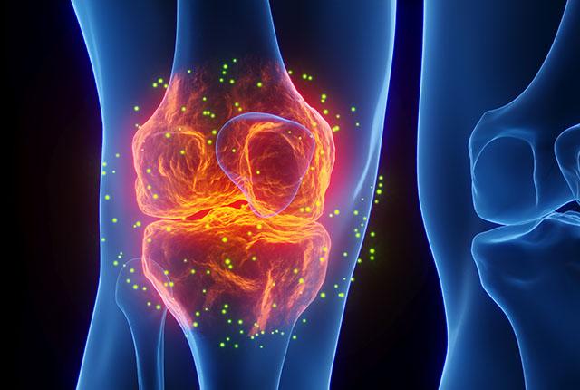 An illustration showing osteoarthritis in the knee.