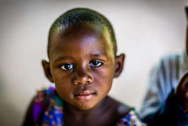 picture of Ugandan boy who has retinoblastoma in one eye