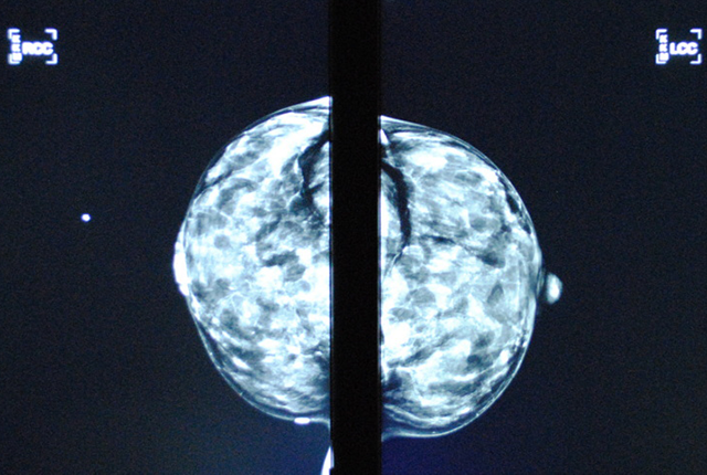 picture showing scans of dense breasts