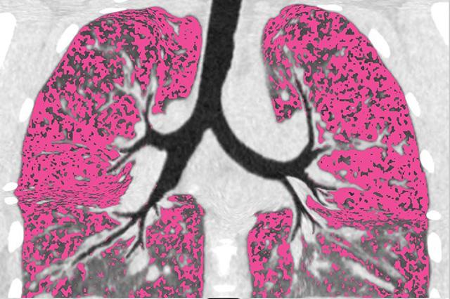 Scan showing air trapped in lungs of a cystic fibrosis patient before modulator treatment