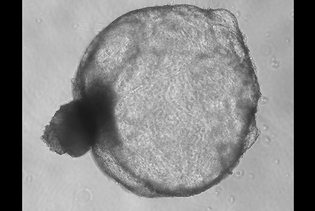 microscopic image of a kidney cyst representing polycystic kidney disease