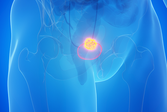 illustration of human abdominal area highlighting bladder cancer