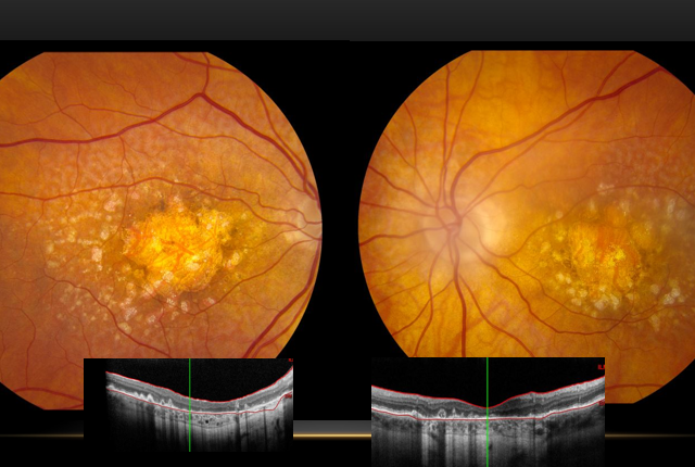 eye scans that show geographic atrophy, a type of macular degeneration