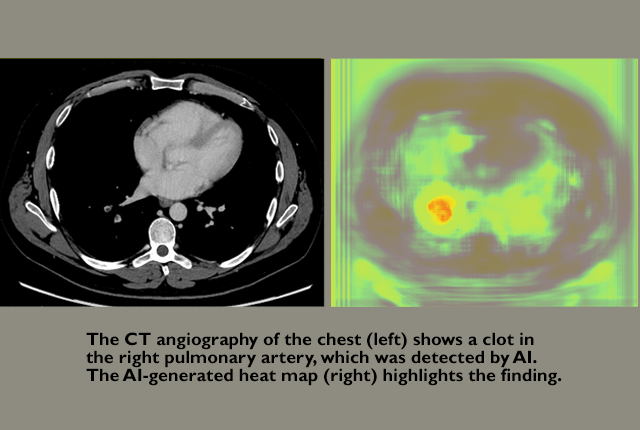 Media Name: ai-radiology-ct-angio.png