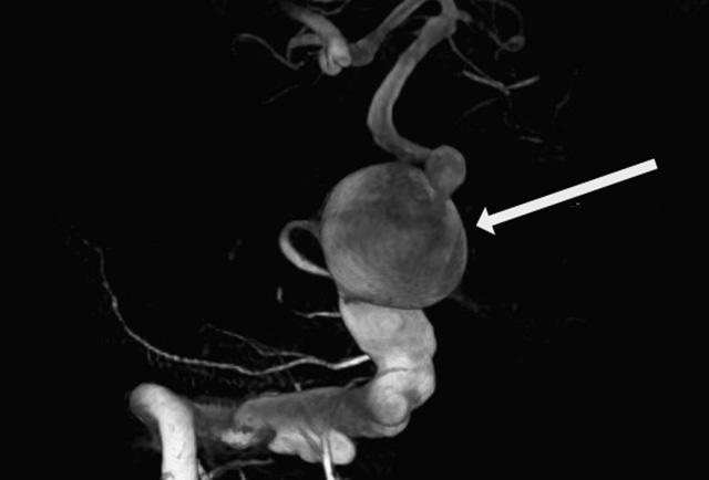 Media Name: aneurysm.jpg