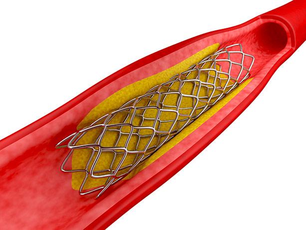 Media Name: coronary_stent_illos.jpg