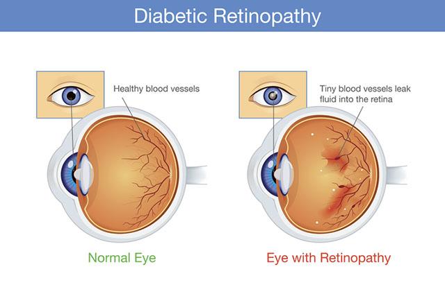 Media Name: diabetic_retinopathy.jpg