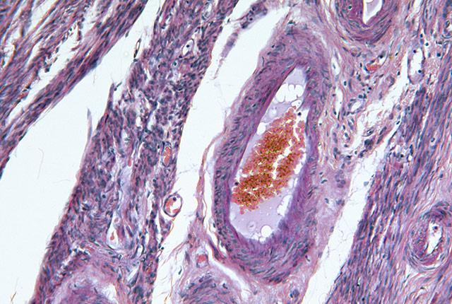 Media Name: endometrial_cancer.jpg