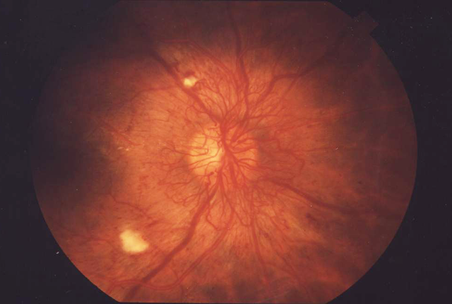 Media Name: fundus_proliferative_retinopathy_eda01.png