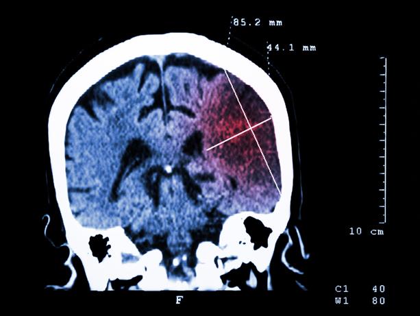 Media Name: ischemic_stroke.jpg