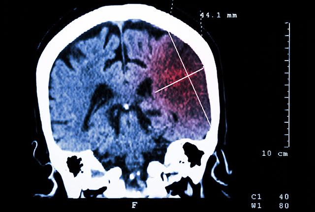 Media Name: ischemic_stroke.jpg