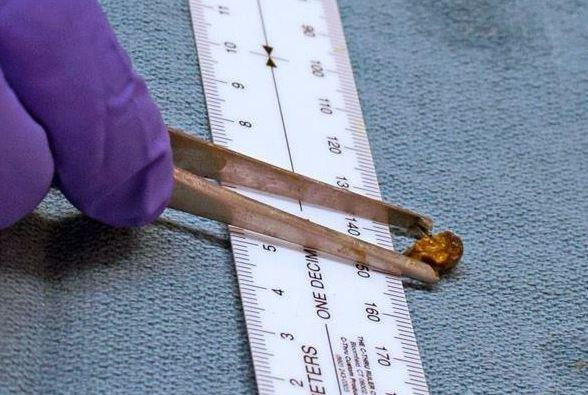 Media Name: kidneystone.jpg