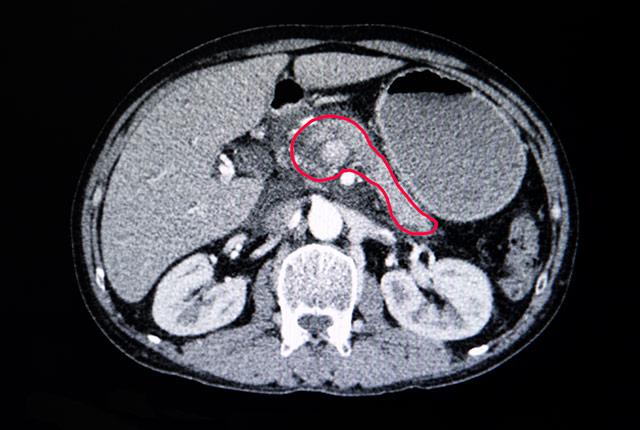 Media Name: pancreatic_cancer_scan.jpg