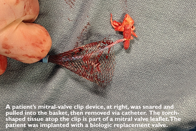 Media Name: removed_mitraclip-2.png