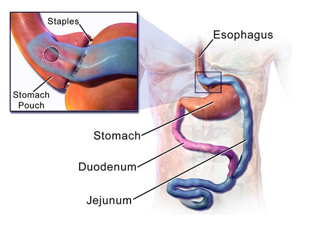 Media Name: roux-en-y_01.jpg