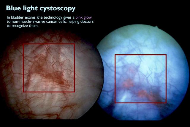Media Name: xblue-light-cystoscopy.jpg