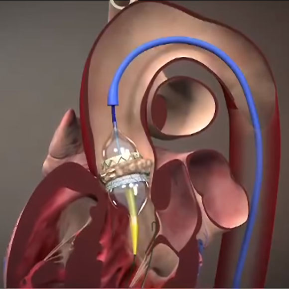 illustration of the Edwards Lifesciences Sapien valve placement
